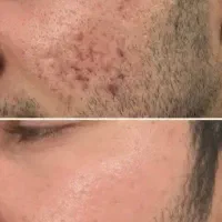 پک تخصصی جوش وضدجوش