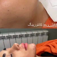 تزریق فیلر بادی با اخرین تخفیف ۶۰درصدی