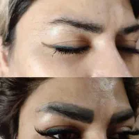 پاک کردن تتو صورت وبدن  بادستگاه  لیزر  کیوسوئیچ