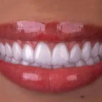 دندانپزشکی ، کامپوزیت ، عصب کشی ، روکش
