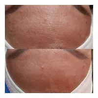 فیشال و پاکسازی صورت و بدن حرفه ای فقط بانوان