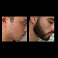 پرپشتی ریشات تضمینیه با سرم ما