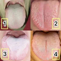 تشخیص بیماری از روی عکس زبان