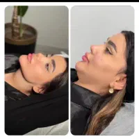 لیپو ساکشن غبغب وی لاین+ بلفارو+هیپ دیپ+اقساطی