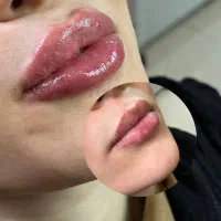 تخفیف بوتاکس(فقط۸۵۰)
