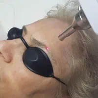 حذف و لیزرتتو ابرو و بدن