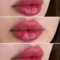 ژل و بوتاکس زیر نظر پزشک آف %20