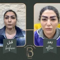جشنواره تابستانه بلفاروپلاستی