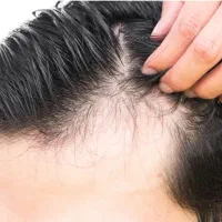 تقویت مو ، رشد مجدد و جلوگیری از ریزش مو