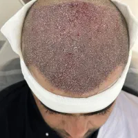 کاشت تخصصی مو/ابرو/پی ارپی پرتراکم ترین کاشت مو،