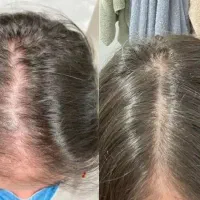 رویش و پرپشتی ریش سبیل تضمینی