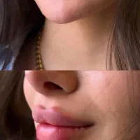 اموزش فیلر ، بوتاکس