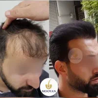 جشنواره‌کاشت‌مو(VIP)۲۴تومن کاشت ابرو۱۴‌(اقساط)