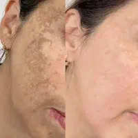 ضدلک و سفیدکننده (حاوی روغن کبوتر و نخل)