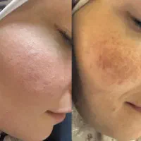 فیشال کربوکسی پلاژن اسید تراپی