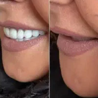 دندانسازی/دندان مصنوعی/حداقل قیمت/ بدون لقی و اذیت