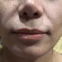 تزریق فیلر و بوتاکس
