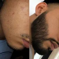 سرم معجزه پرپشتی