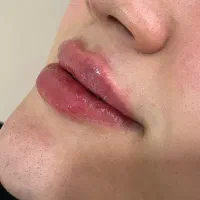 تزریق فیلر لب