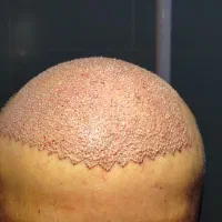 آموزش کاشت مو