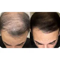 رویش کامل و دائمی