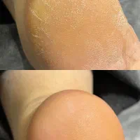 پدیکورتخصصی و درمانی - درمان ناخن اسیب دیده