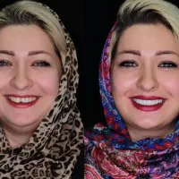 دندانپزشکی اقساط ایمپلنت کامپوزیت لمینیت قسطی