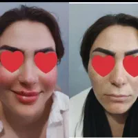 تزریق ژل بوتاکس کل صورت