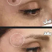 برداشتن خال گوشتی وکک ومک