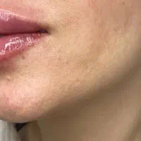 بوتاکس، ژل لب و جوانسازی  پزشک قیمت ویژه قصردشت