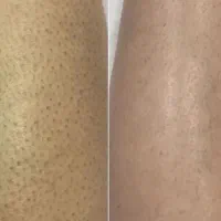 تنها مرکز لیزر تضمینی شاتی و رولی