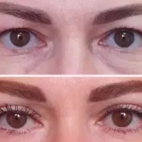 بلفارو تخصصی با بخیه جذبی و شرایط اقساط