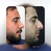 عمل بینی/جراحی بینی