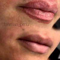 ریموو تخصصی تتو فقط در یک مرحله در اهواز