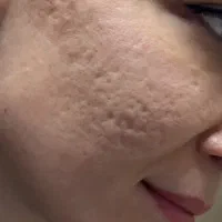 پاک کردن ننو ریر نظر پزشک