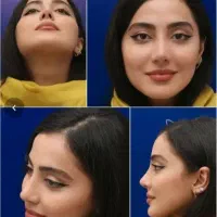 جشنواره جراحی بینی بدون تامپون،لیفت،اقساط