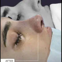جراحی و عمل بینی با تخفیف 50 درصد ،لیفت صورت