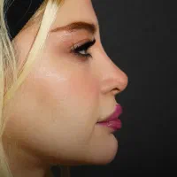 تخفیف ویژه جراحی بینی