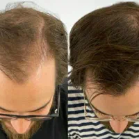 جدید ترین روش درمانی روز دنیا