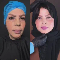 تزریق فیلر و بوتاکس و مزو تراپی درمانی  توسط پزشک