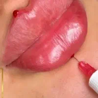 ژل و بوتاکس ۴۰%آف درمطب