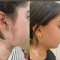 دیگه وقتشه پیسی و پسوریازیس و درمان کنی
