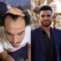 کاشت مو ابرو ریش با شرایط اقساطی