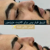 تزریق ژل (فیلر) وبوتاکس و لیفت بانخ ومادلینگ|خدمات آرایشگری و زیبایی|تهران, هفت حوض|دیوار