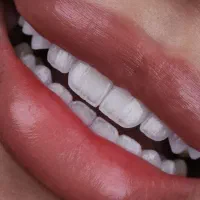 دندانپزشکی کامپوزیت لبه شیشه ای فکی ۸