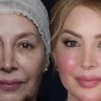 ژل بوتاکس فیلربادی مزو پی ار پی در مطب زیبایی