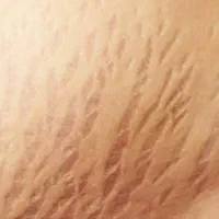 رفع ترک های پوستی با نصف قیمت