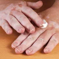 دیگه از پنهان کردن لکههای سفید خسته شدی