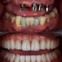 خدمات تخصصی ایمپلنت