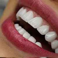 جشنواره ی لمینت دندان( به مدت محدود)